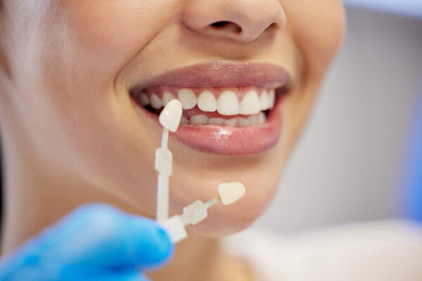 7 Common Problems in Cosmetic Dentistry (Porcelain Veneers)