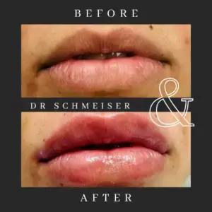 Dental implants before and after by Kendall Breeze Dental Centers