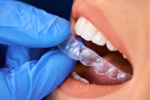 Clear Aligners Orthodontics