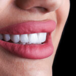 red lips and ceramic veneer teeth