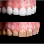 Before and after cosmetic dentistry results at Kendall Breeze Dental
