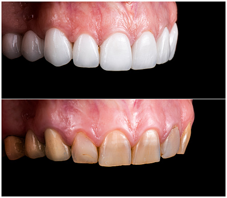 Before and after cosmetic dentistry results at Kendall Breeze Dental