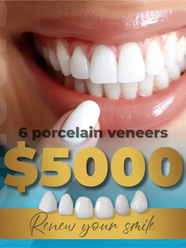 Veneers-Ingles